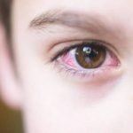 Ini Penyebab dan Cara Mengatasi Mata Merah pada Anak